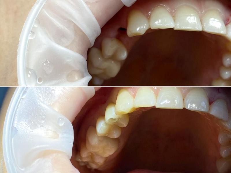 импланты зубов 