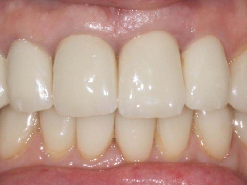 импланты зубов 